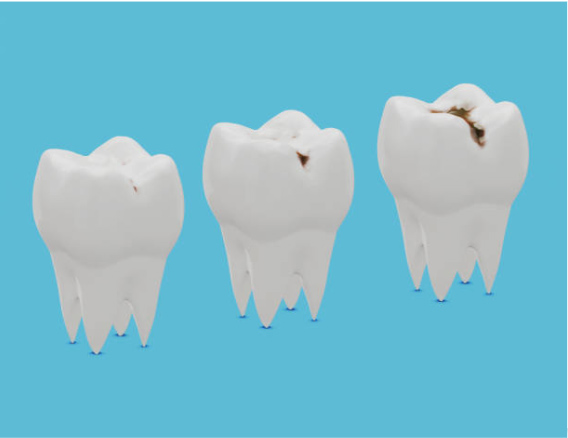 乳歯にはこのような特徴があるため、非常にむし歯になりやすい環境にあるのです。