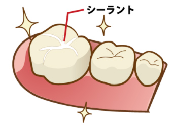 シーラント処置（歯の溝からの虫歯を防ぐ）