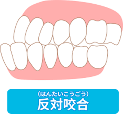 ⑤反対咬合