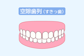 ⑥空隙歯列